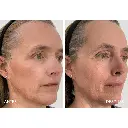Profhilo Structura 3.webp