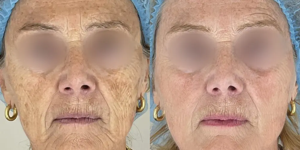 antes y despues-02.webp