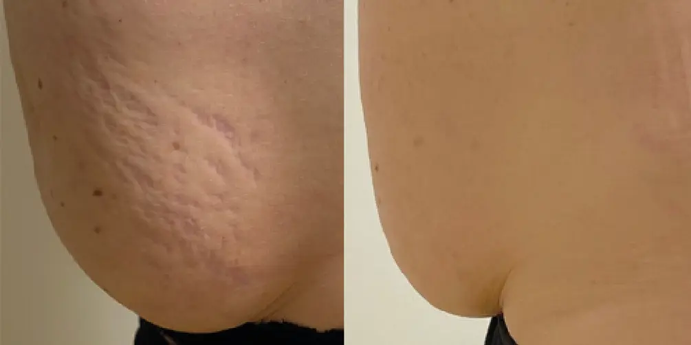 antes y despues-03.webp
