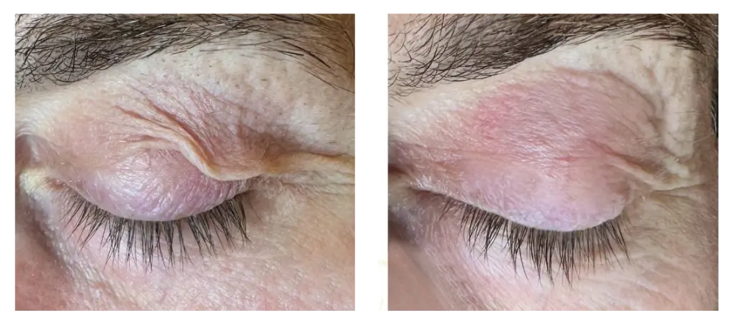 Antes y después 13.webp