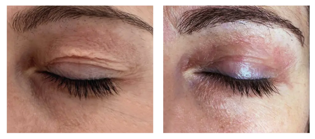 Antes y después 12.webp