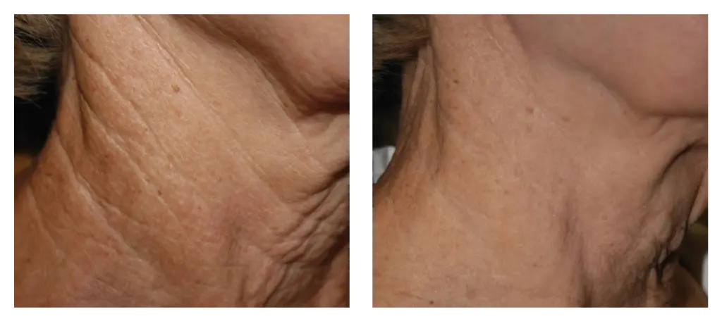 Antes y después 3.webp