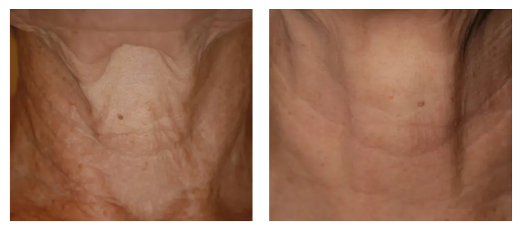 Antes y después 5.webp