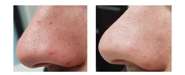 Antes y después AGAIN PRO 2.webp