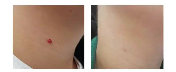 Antes y después AGAIN PRO 1.webp