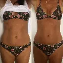 CMSLIM Antes y despues - Abdomen frontal.webp
