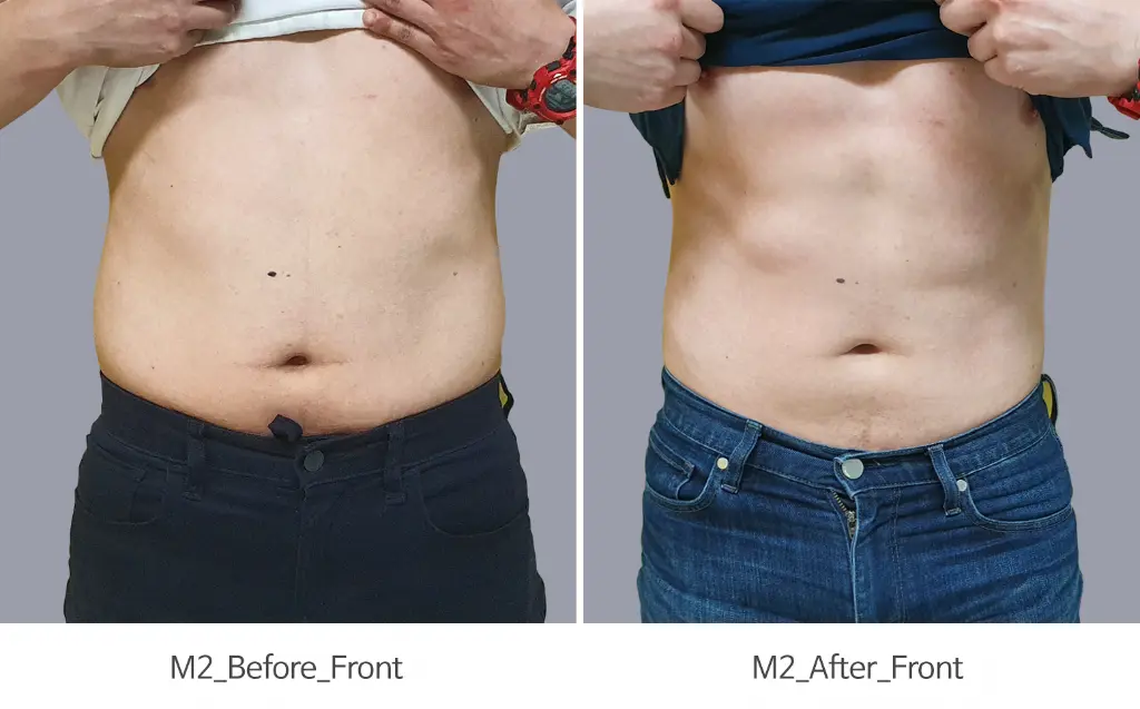 CMSLIM Antes y despues - Abdomen masculino 02.webp