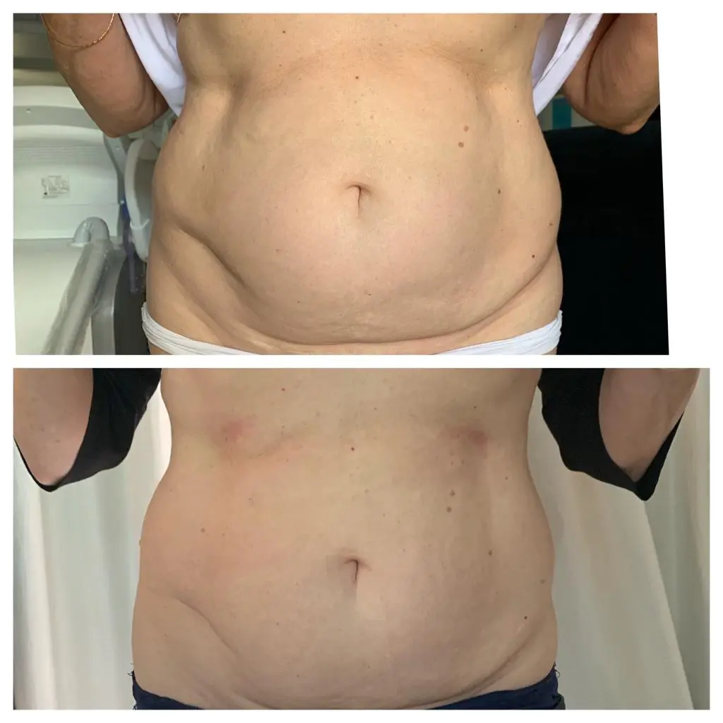 CMSLIM Antes y despues - 01.webp