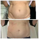 CMSLIM Antes y despues - 01.webp
