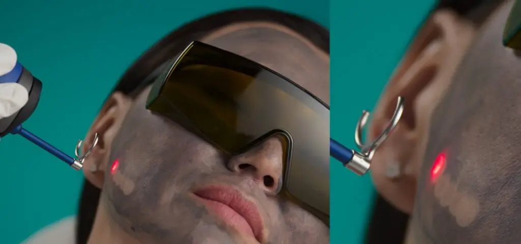 Laser-q-switched-TORO-melasma-lesiones-pigmentadas-DEKA-10-DEKA-PEEL-1024x479.webp