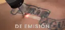 Laser-q-switched-TORO-melasma-lesiones-pigmentadas-DEKA-5-1024x484.webp