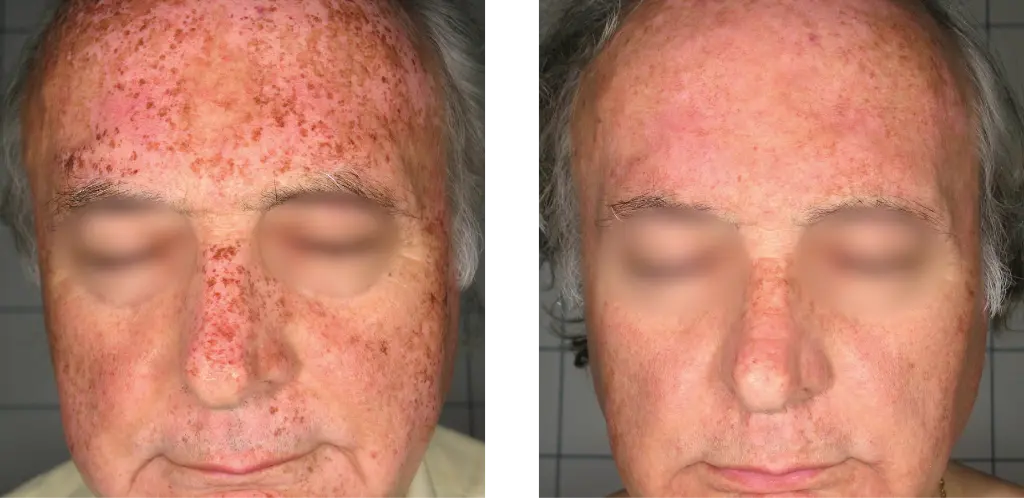 antes y despues-05.webp