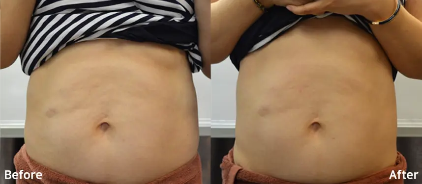 Doublo Antes y despues - 7.webp