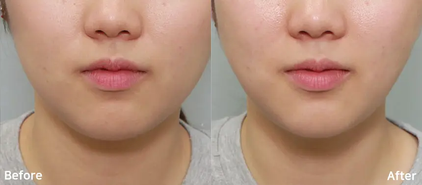Doublo Antes y despues - 1.webp