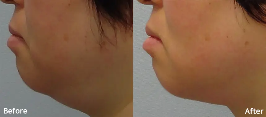 Doublo Antes y despues - 8.webp