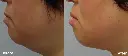 Doublo Antes y despues - 8.webp