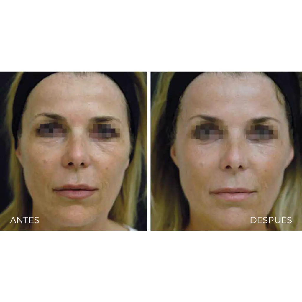 Viscoderm 3.webp