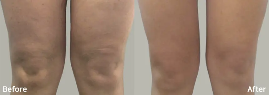 Doublo Antes y despues - 6.webp