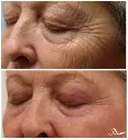 Plexr rejuvenecimiento Periocular y Mejillas.webp