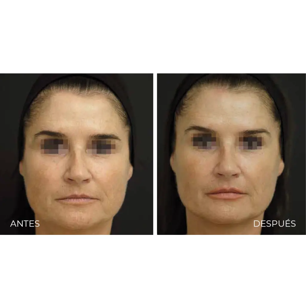 Viscoderm 4.webp