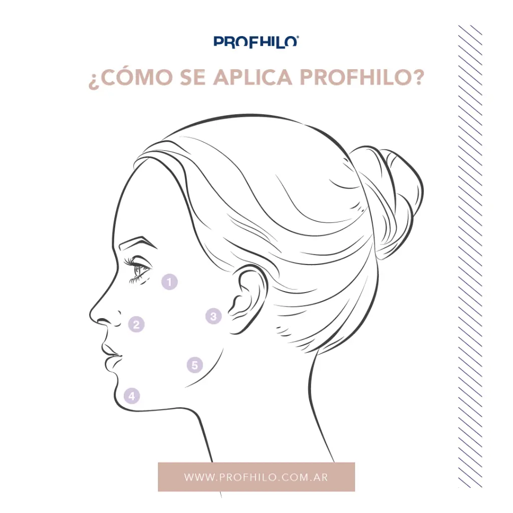 feed_zonas aplicacion profhilo.webp
